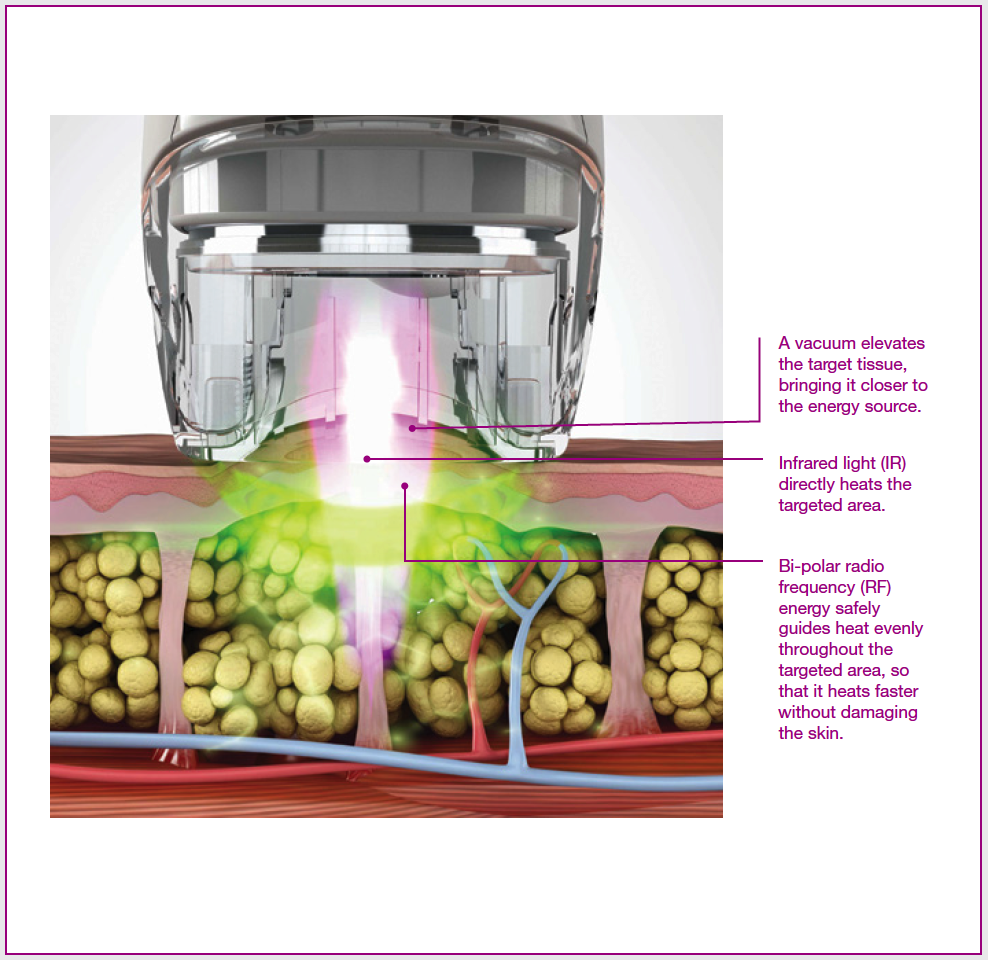 Diagram of how cellulite treatment works