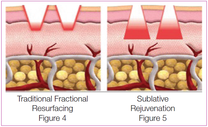 Diagram with difference between traditional skin resurfacing and skin rejuvenation treatment