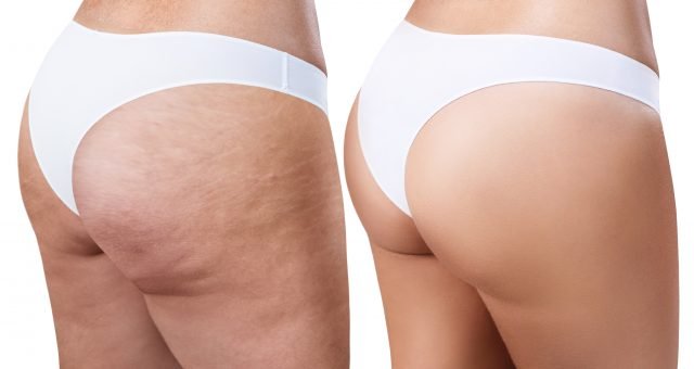 Before and after of same bottom for cellulite treatment