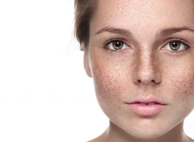 SRA Skin Treatment | Skin Treatments Canberra Freckled Lady's face after receiving SRA Treatment