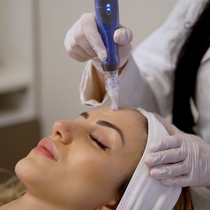 Transformative Benefits of SkinPen Microneedling